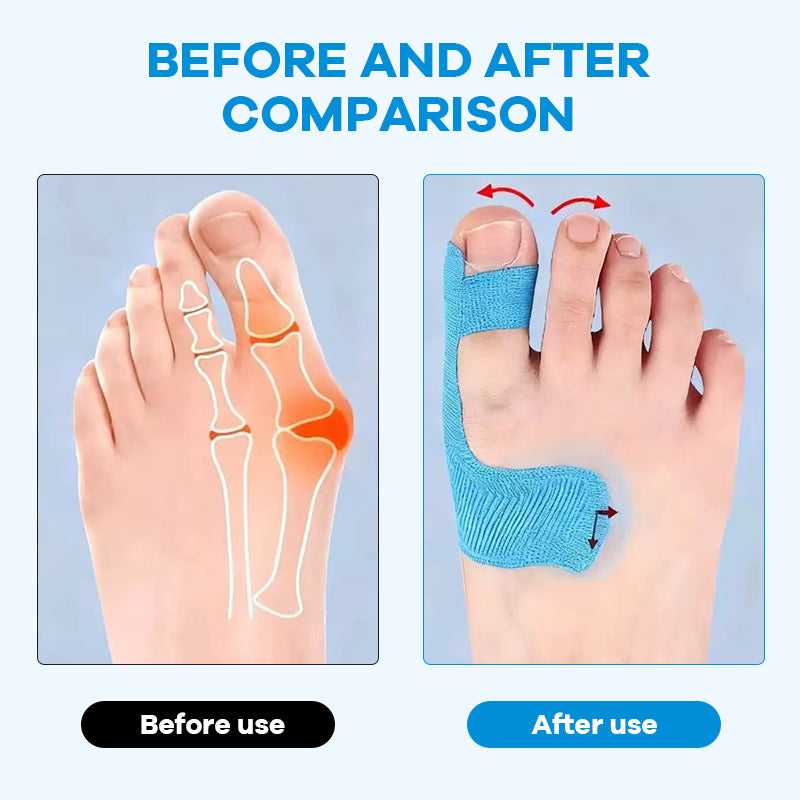 Ferdigskårne kinesiologiske teipbånd, egnet for hallux valgus